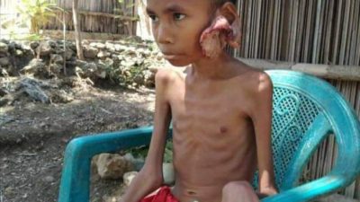 Bocah  Pengidap Kanker Asal Kabupaten Kupang di Tolak Pihak Rumah Sakit W.Z. Yohanes