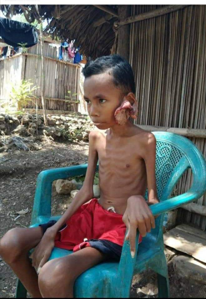 Foto.Martinus Bait, bocah penderita kanker asal Kabupaten Kupang.