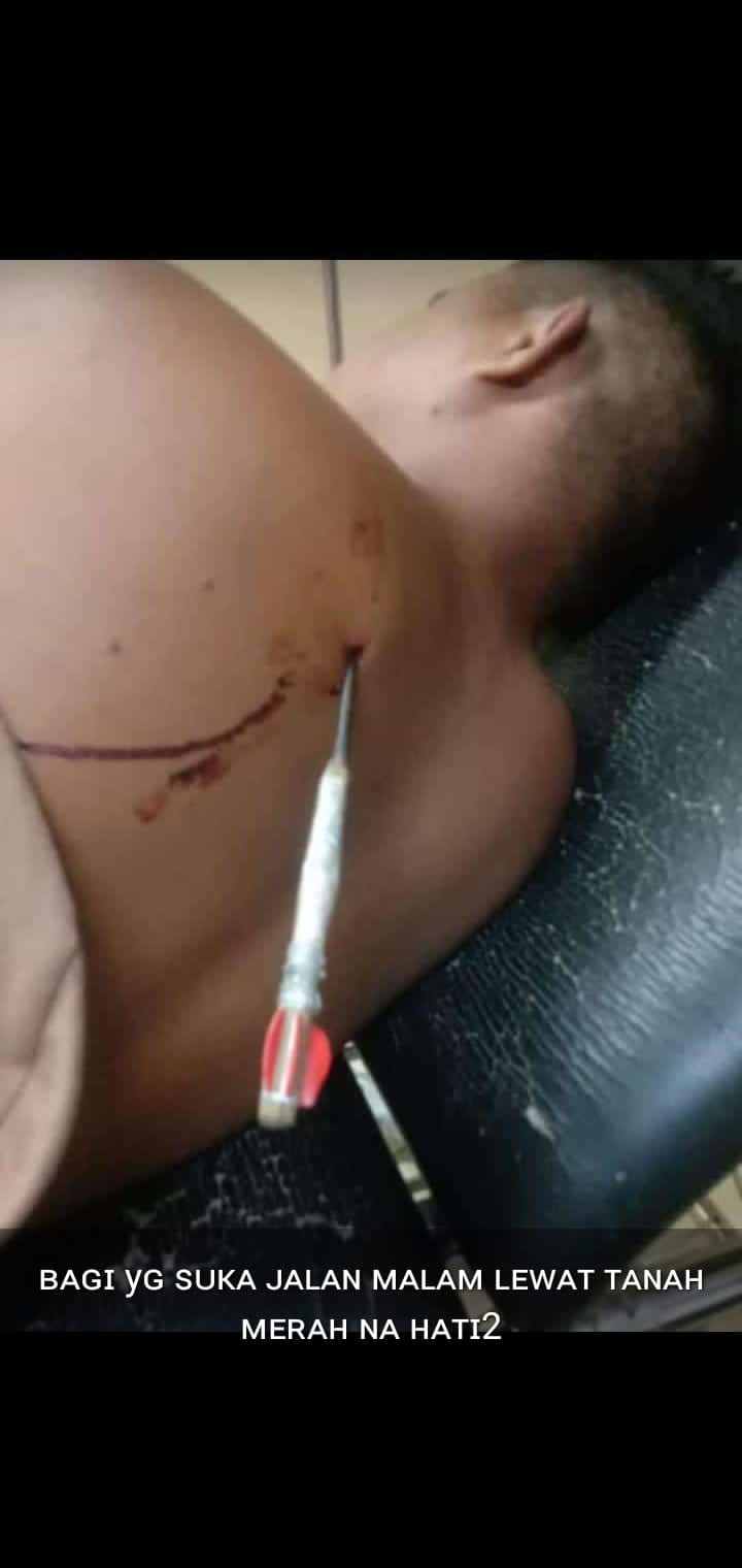 Foto. Korban Ozias Dez Oscar Henuk mengalami luka serius usai terkanah panah Ambon pada pada bahu kiri bagian belakang.